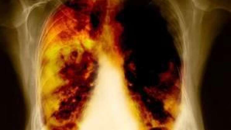 En México uno de cada 10 pacientes con cáncer de pulmón se salva