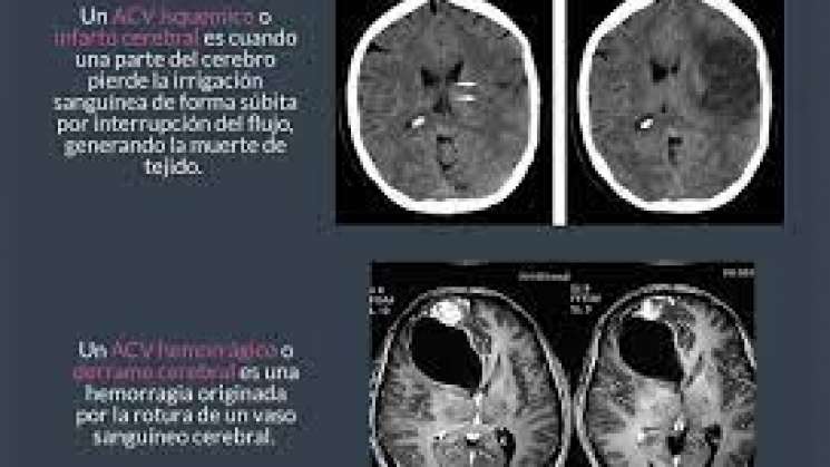  Campaña de concientización sobre el Infarto Cerebral
