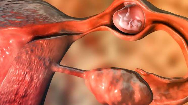 Embarazo ectópico, entre causas más frecuentes de muerte materna