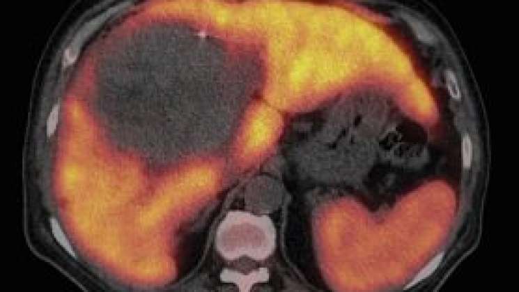 Alertan por hongos que causan 30 % de casos de cáncer de hígado