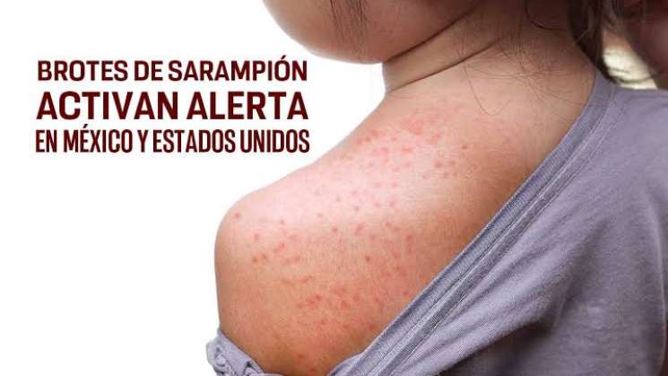 Más de 4 mil contagios y 15 muertes por Sarampión en México 