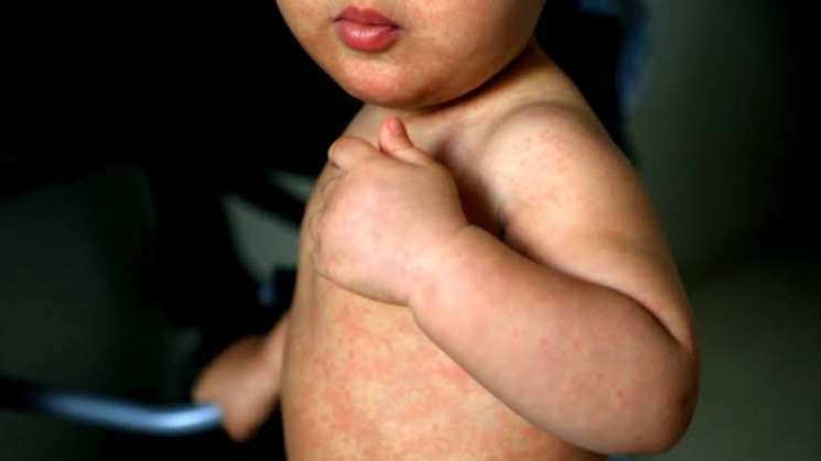 SSA confirma 17 muertes por sarampión en México 